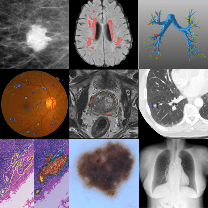 Ai for Cancer Detection